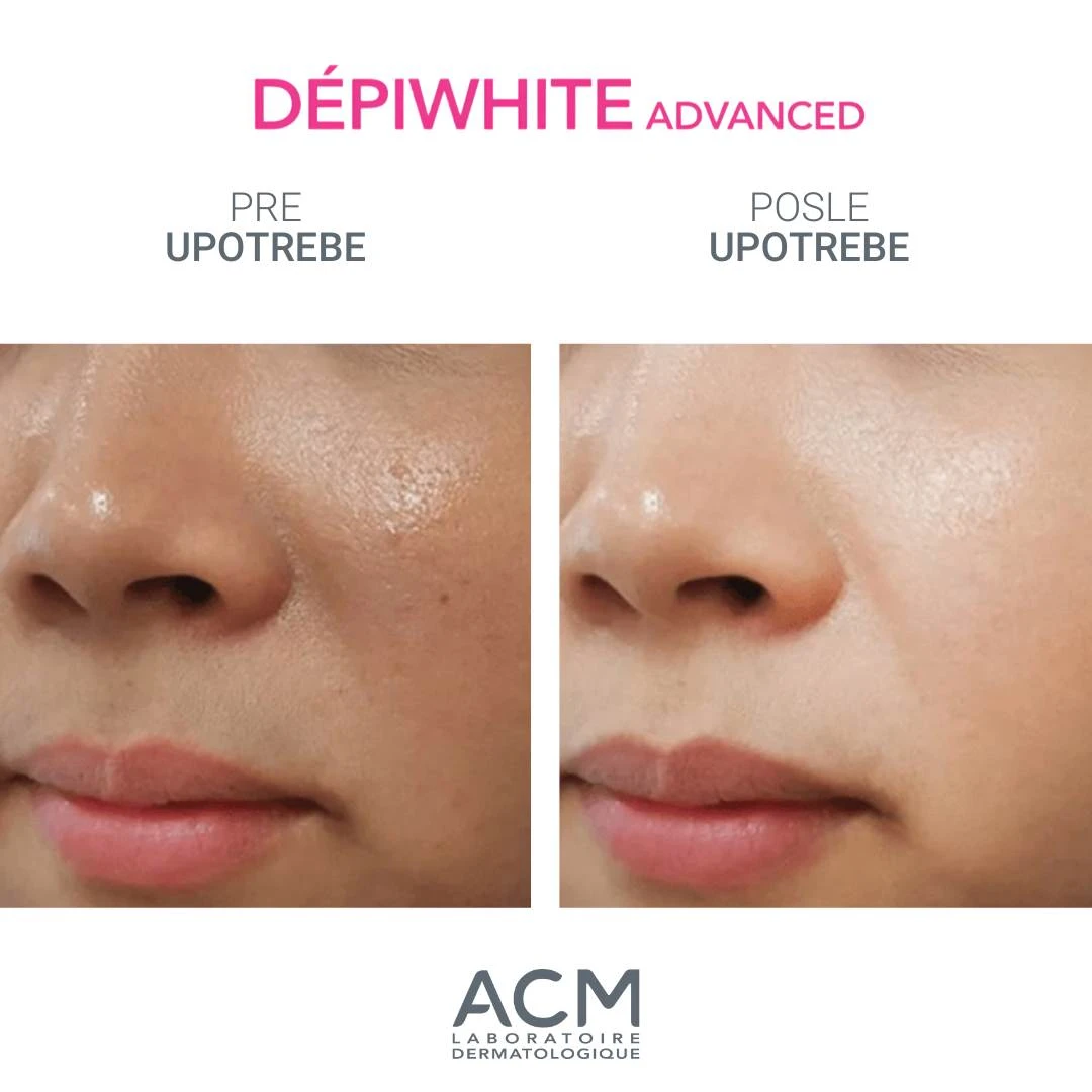 ACM DEPIWHITE Advanced Krem Protiv Braon Pega i Hiperpigmentacija 40 mL