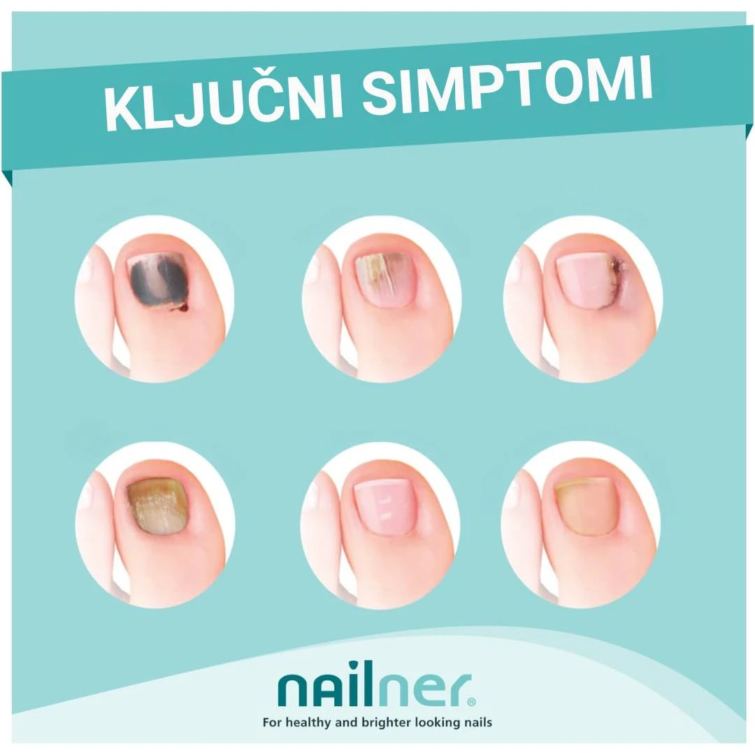 Nailner Lak 2u1 za Tretman Gljivičnih Infekcija Noktiju 5 mL